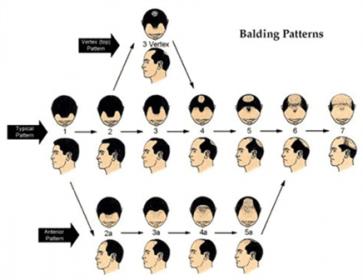 Click image for larger version

Name:	balding pattern.jpg

Size:	15.0 KB
ID:	4875