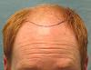 Click image for larger version

Name:	1b_position-of-hairline_ryl.jpg

Size:	89.6 KB
ID:	47477
