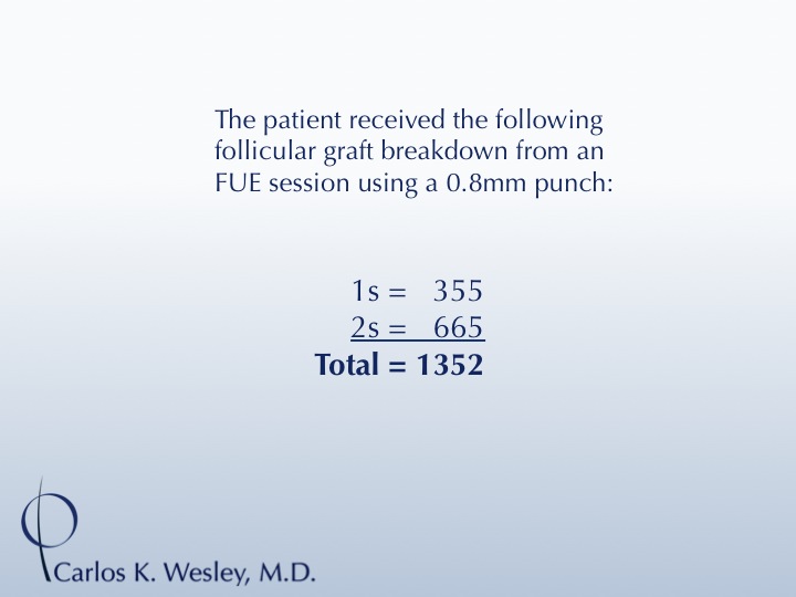 1352 FUE grafts to frontal region