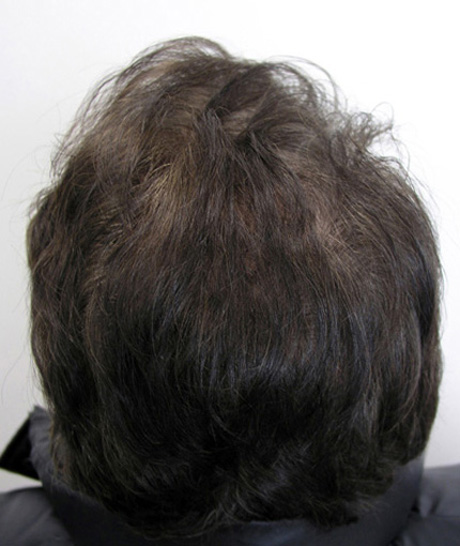 After 1 FUT: 2012 follicular units in the front and Propecia usage for vertex