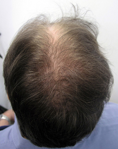 Before hair transplantation