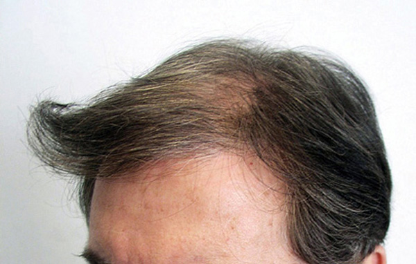 Before hair transplantation