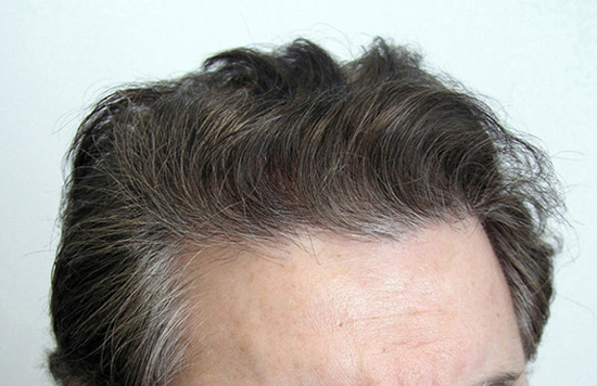 After 1 FUT:  2012 follicular units