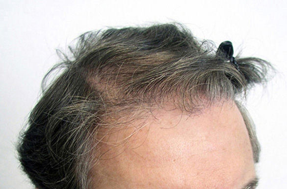 Before hair transplantation