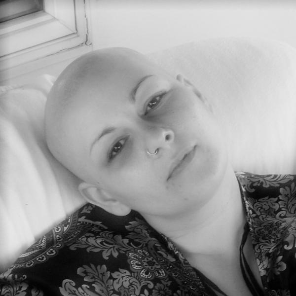 Embracing Alopecia