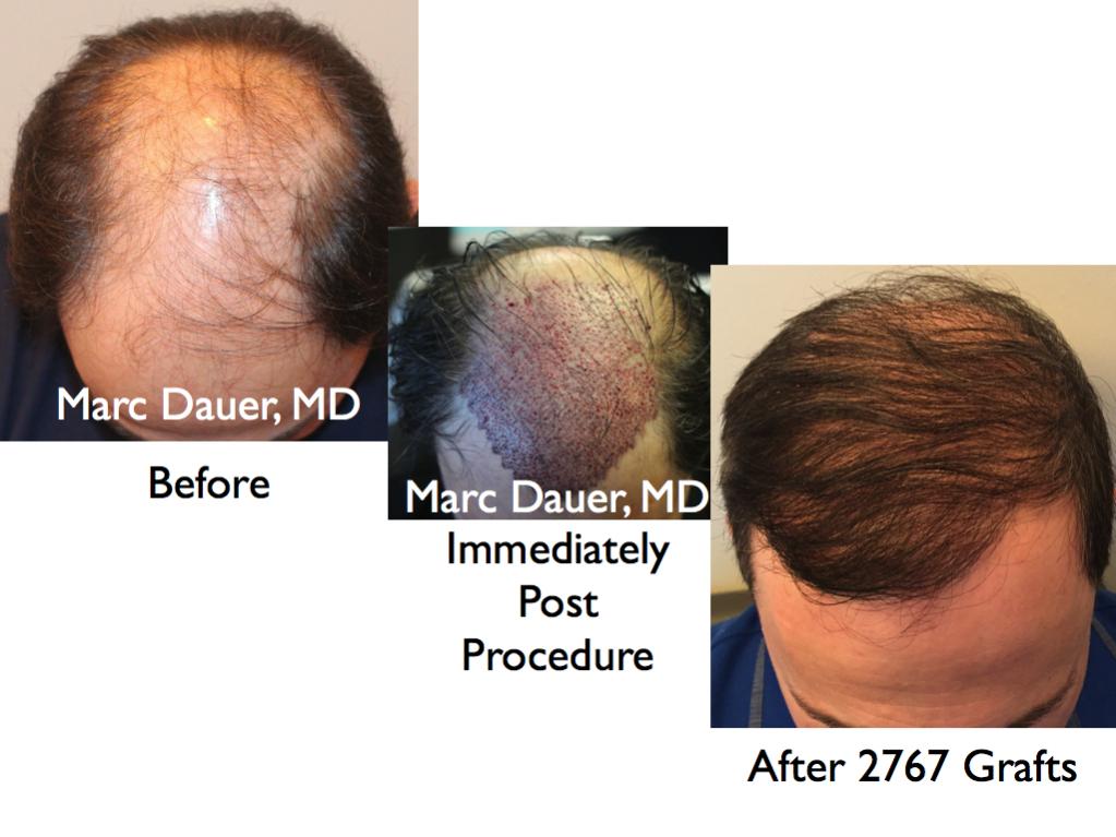 Click image for larger version

Name:	Hair Transplant Slides.557.jpg

Size:	76.4 KB
ID:	38662