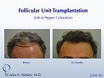46-year-old male with curly hair of salt & pepper coloration underwent two sessions totaling 4637 FU with Dr. Carlos K. Wesley (NYC).