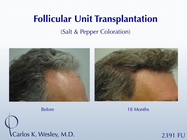 46-year-old male with curly hair of salt & pepper coloration underwent two sessions totaling 4637 FU with Dr. Carlos K. Wesley (NYC).