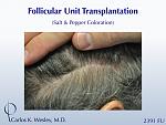 46-year-old male with curly hair of salt & pepper coloration underwent two sessions totaling 4637 FU with Dr. Carlos K. Wesley (NYC).  His resultant...