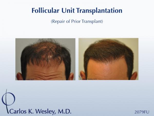 Softening a "pluggy" appearing hairline can be achieved in a single session. This 42-year-old male had previously undergone two hair transplants that...