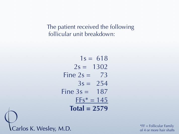 A 34-year-old male had 2579 FU added to his mid scalp to minimize his balding crown.