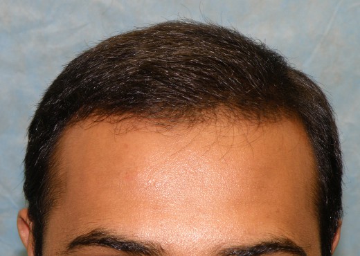 Click image for larger version

Name:	05_after-first-hair-transplant.jpg

Size:	58.7 KB
ID:	6539