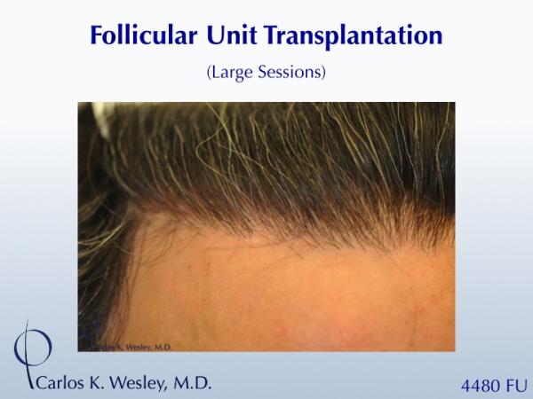 This 43-year-old man desired to reverse the progressive recession of his hairline. A total of 4480 grafts were transplanted to the frontal half of...