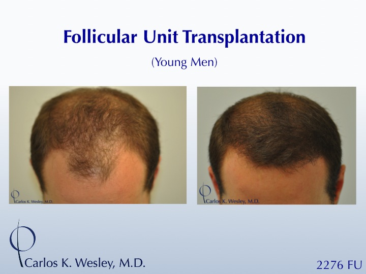 This 28-year-old desired the most natural appearing surgical hair restoration. He elected to have a session with Dr. Carlos K. Wesley in New York...