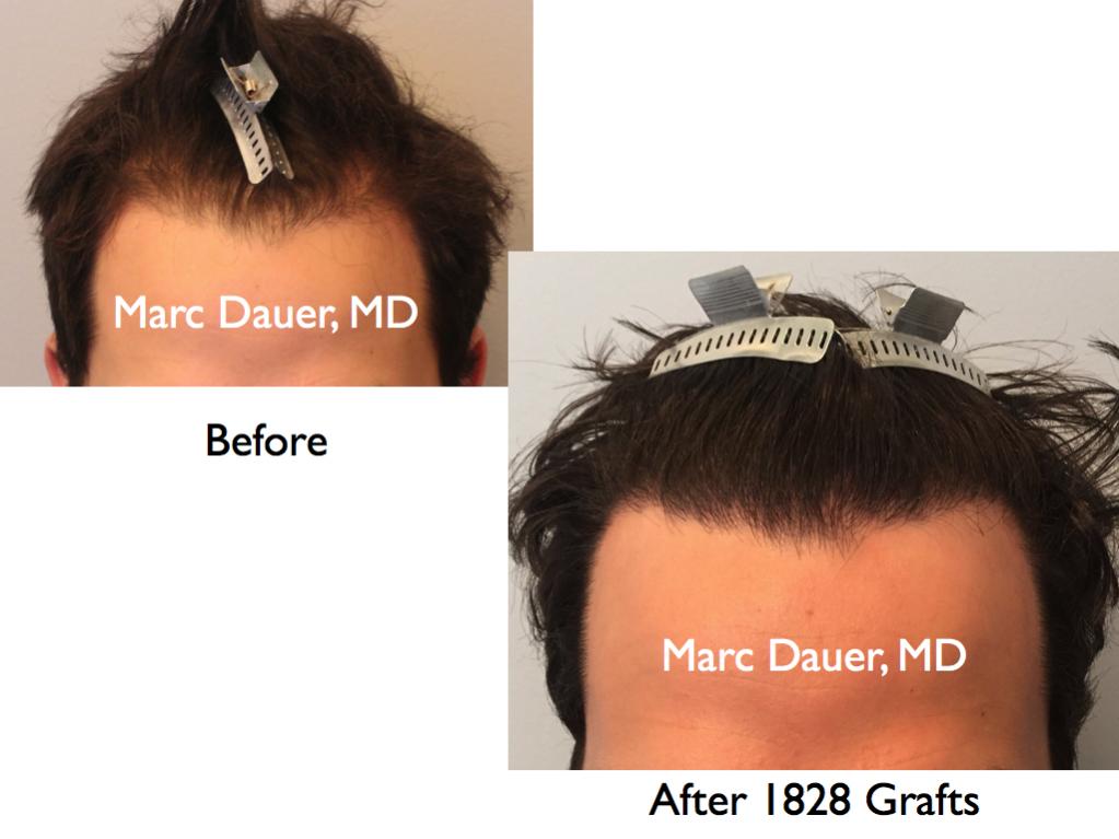 Click image for larger version

Name:	Hair Transplant Slides.605.jpg

Size:	60.7 KB
ID:	39431