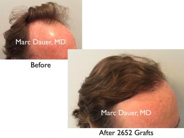 Click image for larger version

Name:	Hair Transplant Slides copy51.003.jpg

Size:	12.6 KB
ID:	46601