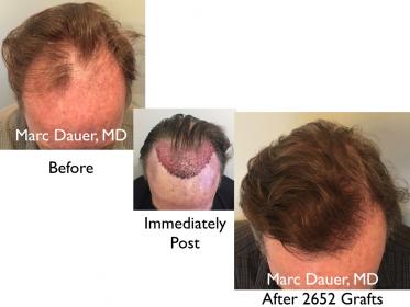 Click image for larger version

Name:	Hair Transplant Slides copy51.004.jpg

Size:	14.1 KB
ID:	46603