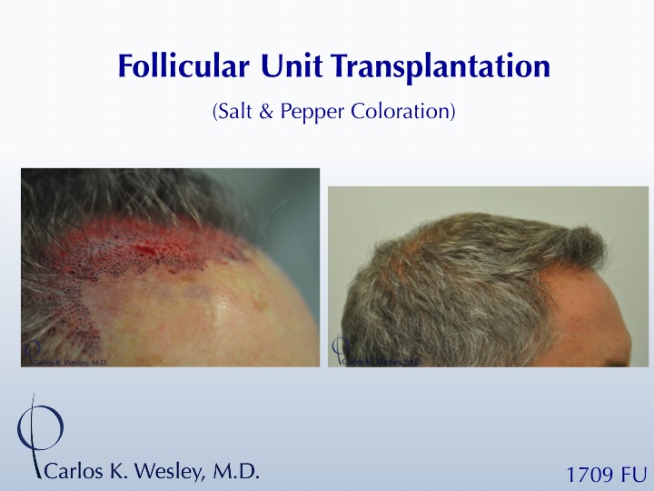 A video montage of this patient's transformation may be viewed here: 
 
https://vimeo.com/67214017