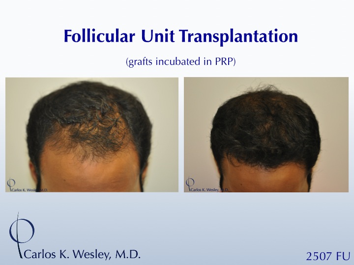 22-year-old male before and after 2507 grafts to the frontal third of his scalp by Dr. Carlos K. Wesley.  A video montage of his transformation can...