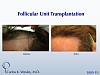 This patient had a session with Dr. Carlos K. Wesley (NYC) to increase the hair density throughout the frontal half of his scalp and improve the...