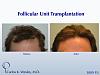 This patient had a session with Dr. Carlos K. Wesley (NYC) to increase the hair density throughout the frontal half of his scalp and improve the...