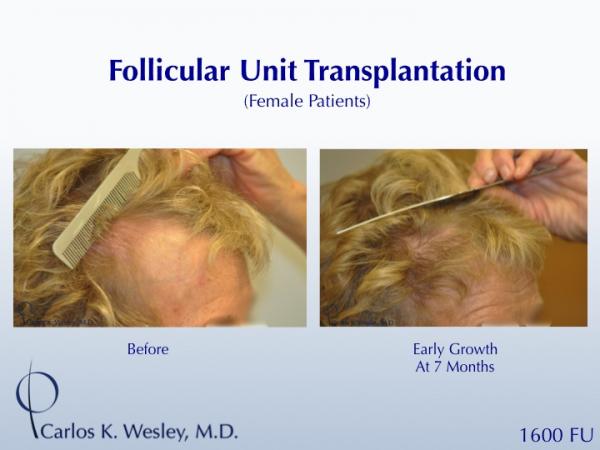 A female patient showing early growth after a 1600FU session with Dr. Wesley.  Her grafts were incubated in chilled PRP during her FUT procedure,...