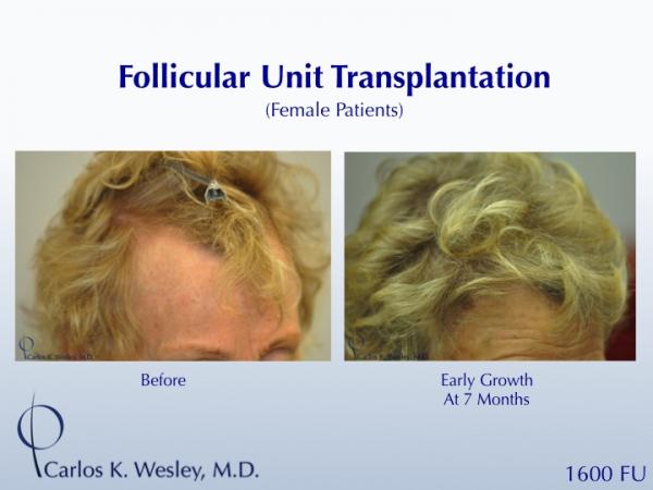 A female patient showing early growth after a 1600FU session with Dr. Wesley.  Her grafts were incubated in chilled PRP during her FUT procedure,...