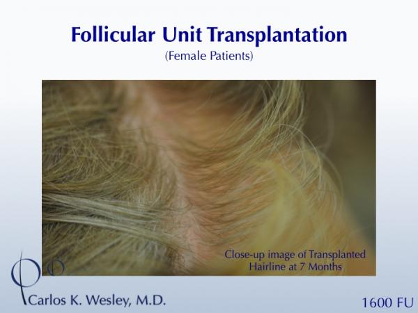 A female patient showing early growth after a 1600FU session with Dr. Wesley.  Her grafts were incubated in chilled PRP during her FUT procedure,...