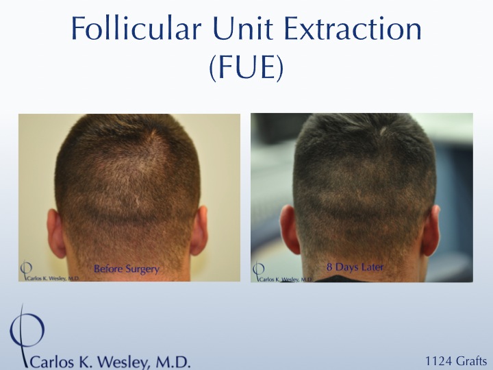 More examples of Dr. Wesley's patients' FUE donor recovery processes can be viewed in this video montage: 
 
https://vimeo.com/70354892