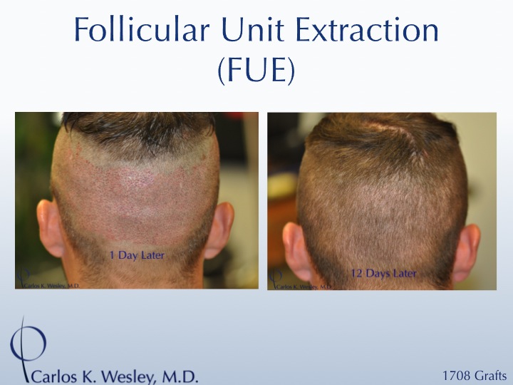 More examples of Dr. Wesley's patients' FUE donor recovery processes can be viewed in this video montage: 
 
https://vimeo.com/70354892