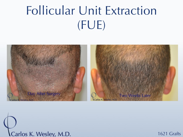 More examples of Dr. Wesley's patients' FUE donor recovery processes can be viewed in this video montage: 
 
https://vimeo.com/70354892