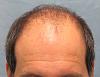 Click image for larger version

Name:	1098_2a_before-hair-transplant.jpg

Size:	45.8 KB
ID:	24514