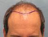 Click image for larger version

Name:	1098_2b_position-of-hairline.jpg

Size:	42.3 KB
ID:	24515
