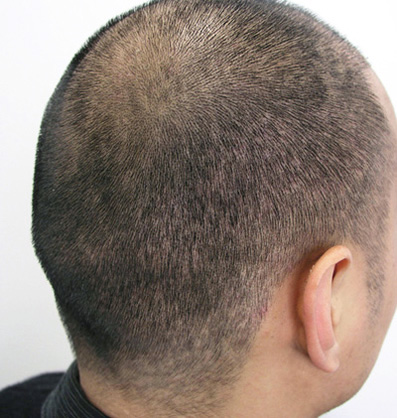 11 days after 1500 FUE