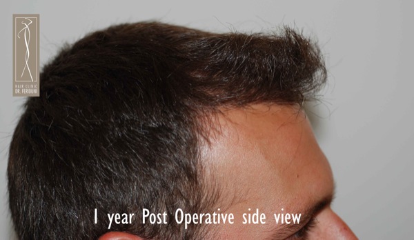 Click image for larger version

Name:	Patient 1 - post operative side view 2.jpg

Size:	58.4 KB
ID:	4793