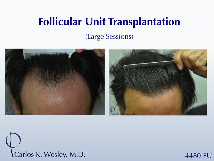 This 43-year-old man desired to reverse the progressive recession of his hairline. A total of 4480 grafts were transplanted to the frontal half of...