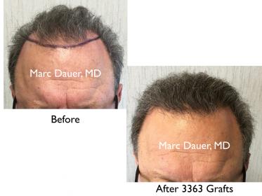Click image for larger version

Name:	Hair Transplant Slides copy21.001.jpg

Size:	14.2 KB
ID:	44272
