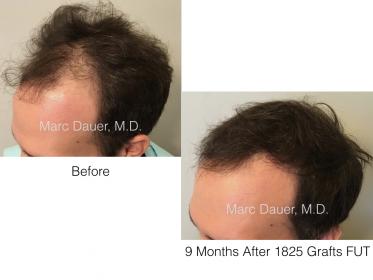 1825 Grafts FUT by Dr. Marc Dauer