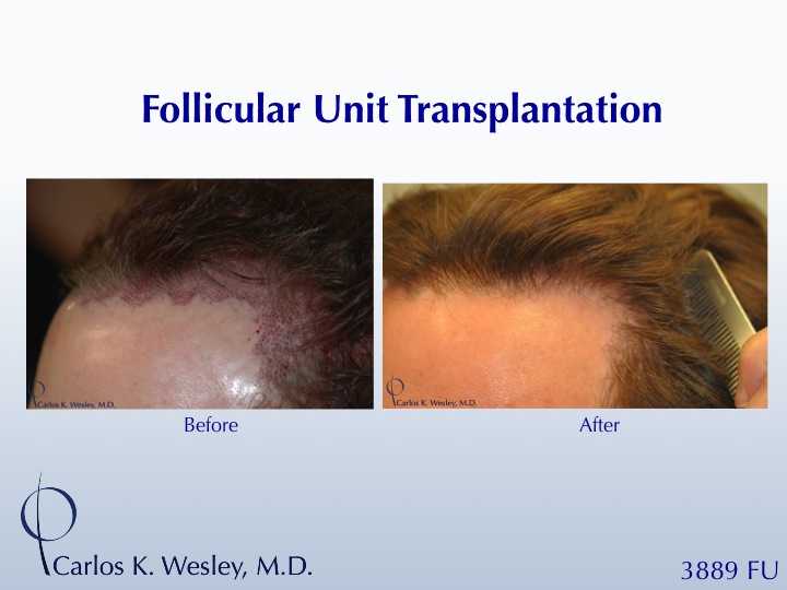 This patient had a session with Dr. Carlos K. Wesley (NYC) to increase the hair density throughout the frontal half of his scalp and improve the...