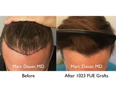 FUE hair transplant by Dr. Marc Dauer
