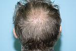 Here is a picture of the grafts from the FUE case just done on my crown.