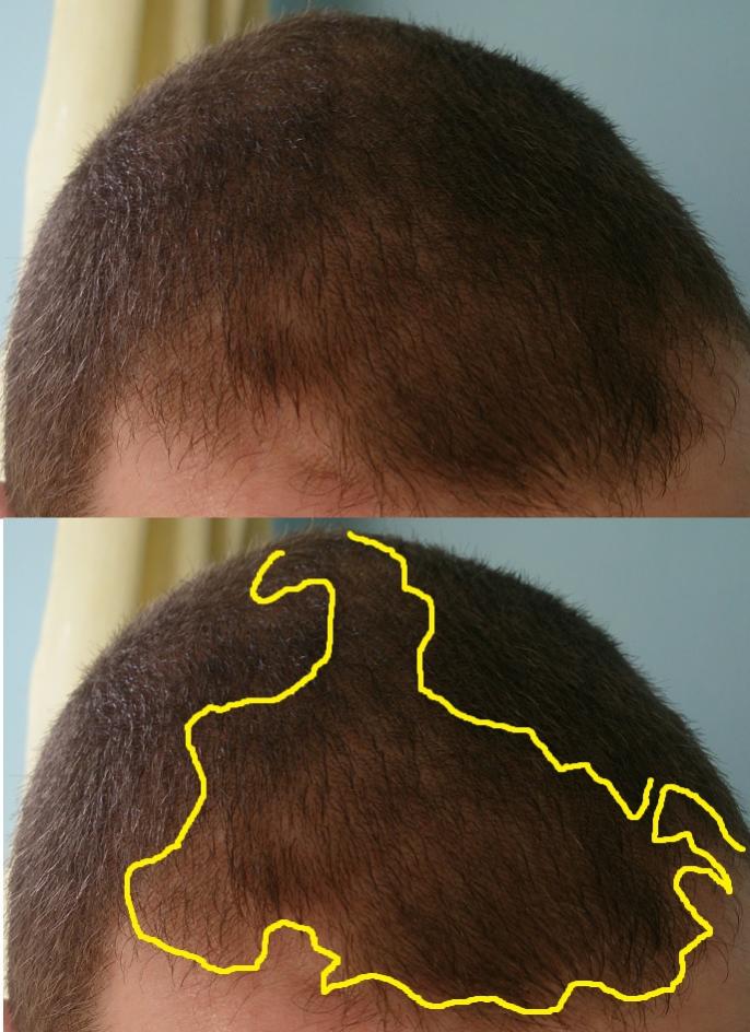 Click image for larger version

Name:	8 Current Hair Loss #3.jpg

Size:	85.7 KB
ID:	36896