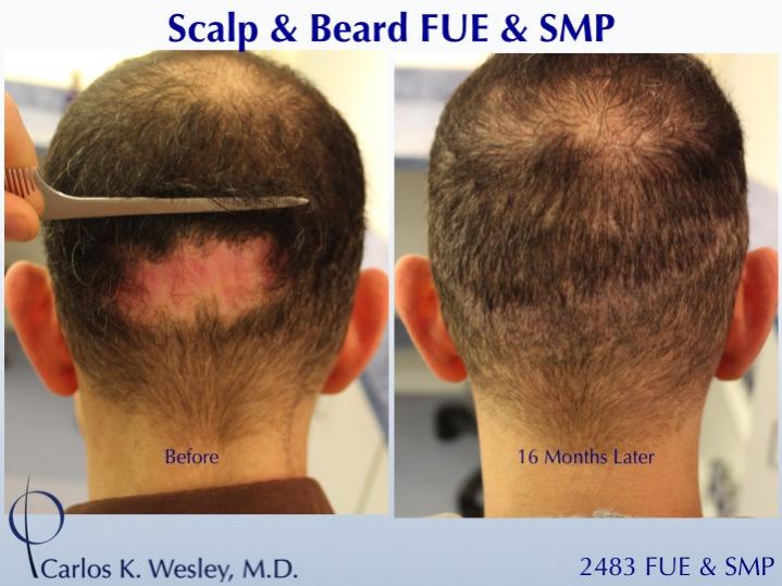 Repairing a Wronged Patient with FUE & SMP