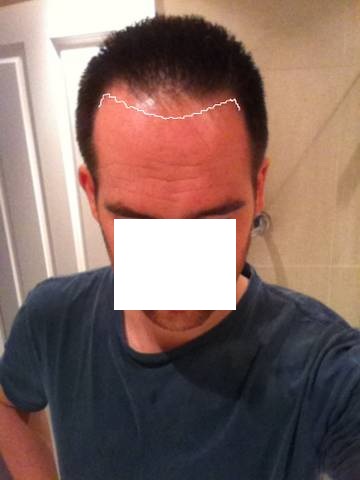 Click image for larger version

Name:	hairline2x.jpg

Size:	30.0 KB
ID:	11062