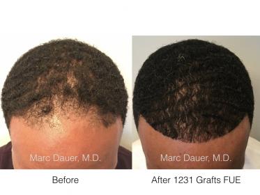 FUE African American Patient