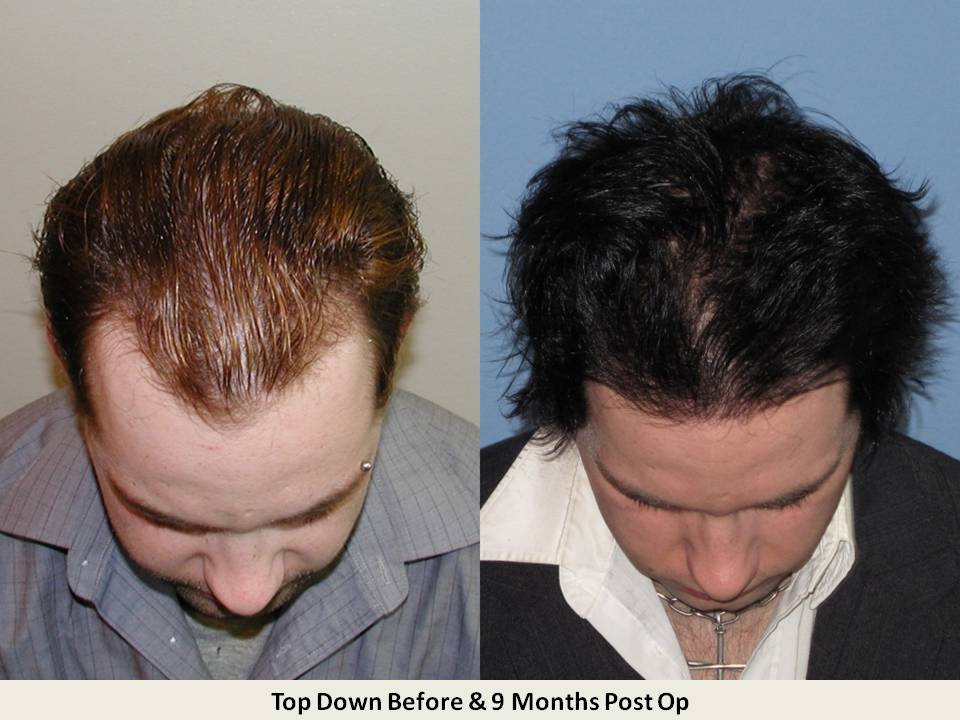 Dr. Paul Shapiro 
FUT 
2631 grafts/4742 hairs 
9 months post-op