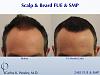Repairing a Wronged Patient with FUE & SMP