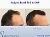 Repairing a Wronged Patient with FUE & SMP