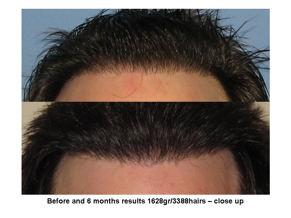 Dr. Paul Shapiro, MD  
FUT  
1628 grafts/ 3388 hairs 
6 months post-op