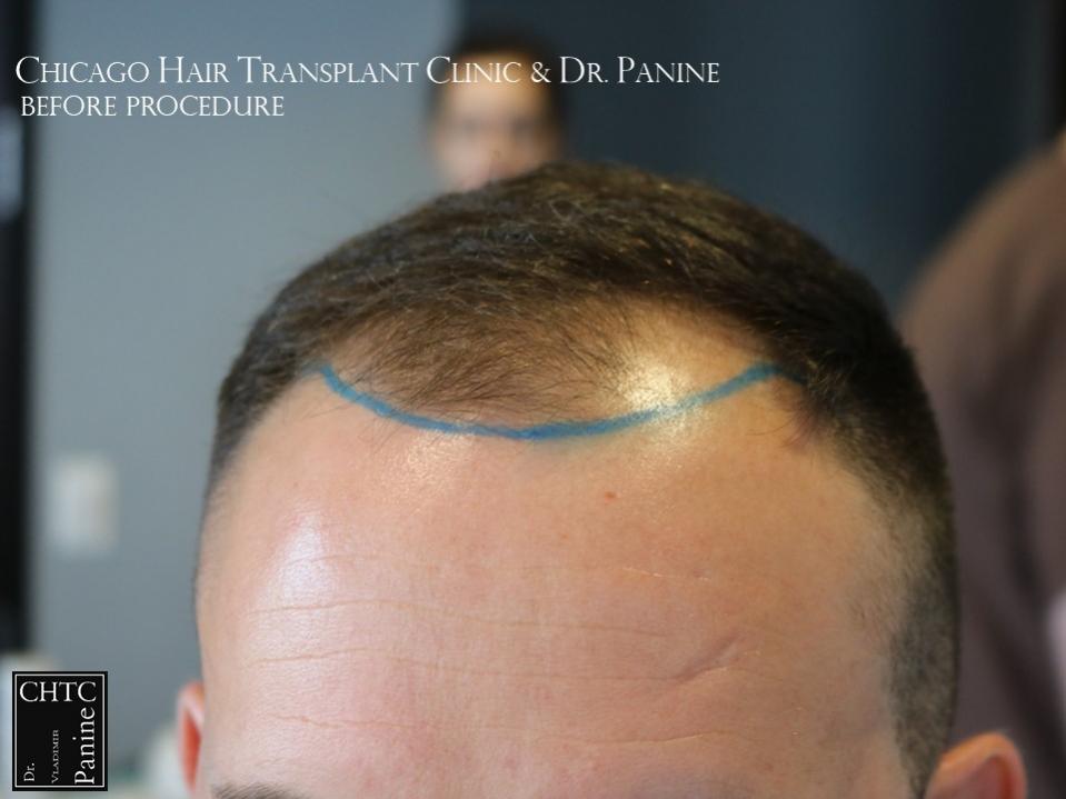 PANINE, MD FUE Hair Transplant Results